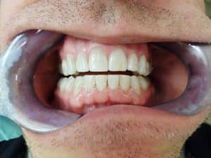 after periodontal treatment