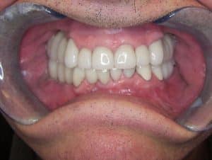 after teeth whitening treatment